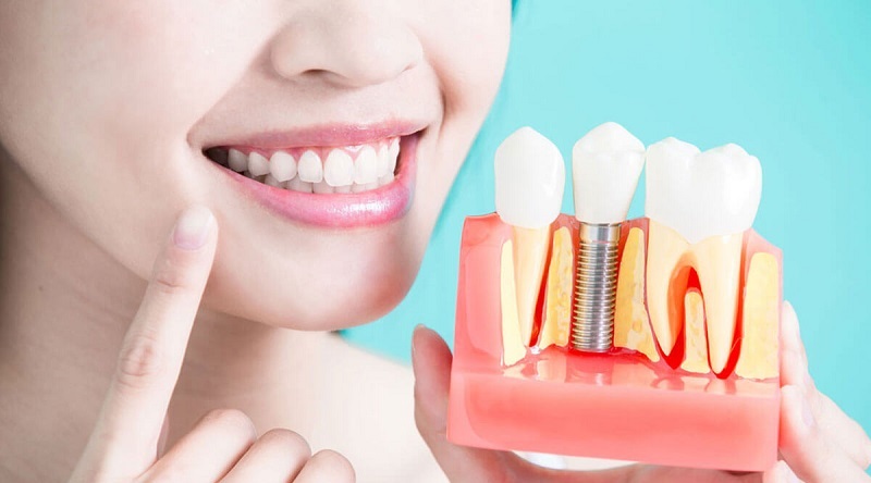 بررسی شرایط کاشت ایمپلنت توسط دندانپزشک خوب