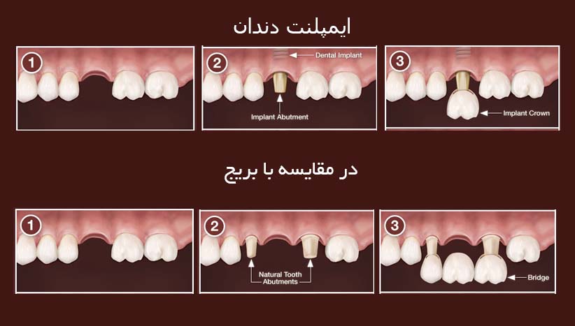 ایمپلنت دندان بهتر است یا بریج