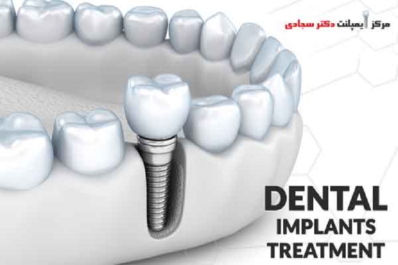 بهترین متخصص ایمپلنت در شیراز