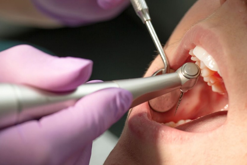 بهترین دندانپزشک متخصص عصب کشی ریشه دندان شیراز